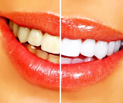 ホームホワイトニング用品