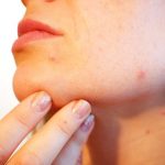 顔(額・頬・Ｔゾーン)にできるイボの種類や原因は？