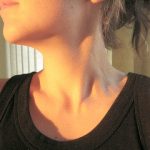 首(胸・脇・デコルテ)にイボができるのはナゼ？その理由や原因